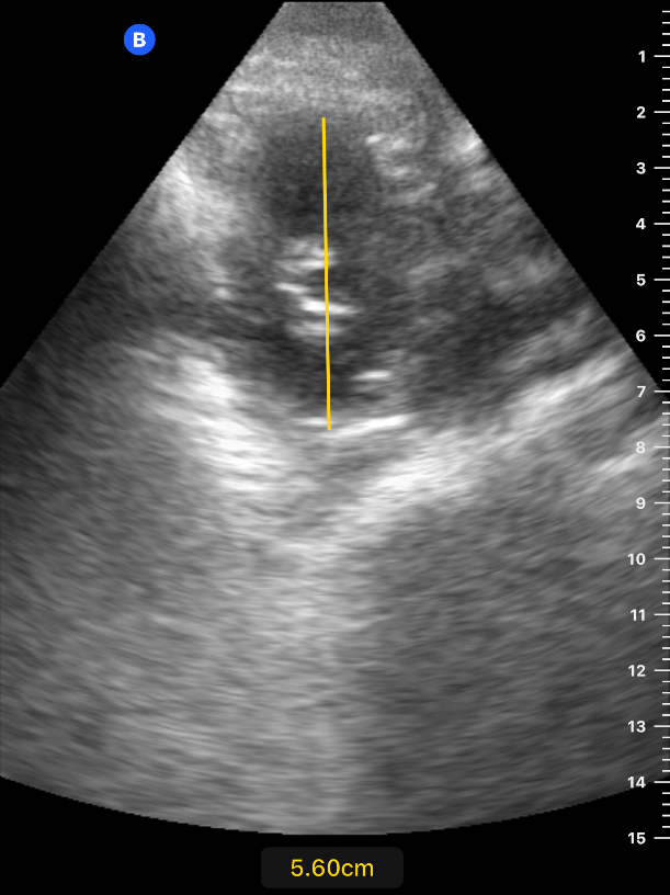 Renal — Ultra Sono